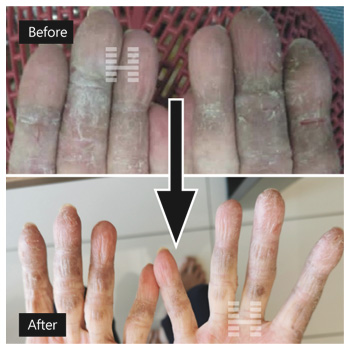 Testimonial for hand eczema, dermatitis or Keratodermia tylodes palmaris progressiva. Homodesty consultation success story, photos shown before and after herbal treatment.