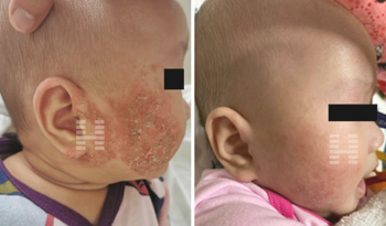 The Homodesty.com testimonial of treating baby's face eczema by Chinese herbs