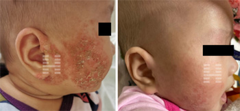 The result of infant eczema treatment by Chinese Herbs