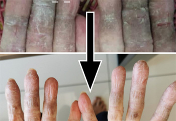Keratodermia tylodes palmaris progressiva, hadn Eczema cured by Chinese medicine supplements