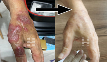 Allergic Reactions After COVID-19 Vaccination And The Result Of Chinese Medicine Treatment